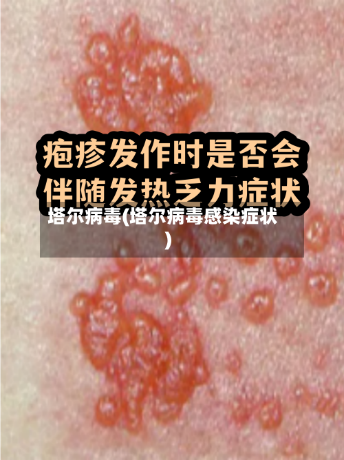 塔尔病毒(塔尔病毒感染症状)-第2张图片